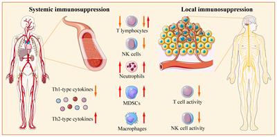 Systemic and local immunosuppression in glioblastoma and its prognostic significance